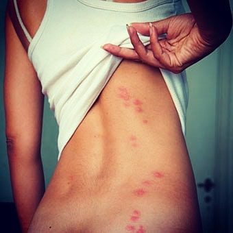 pogryzienia pluskwa pogryzienia pluskwa