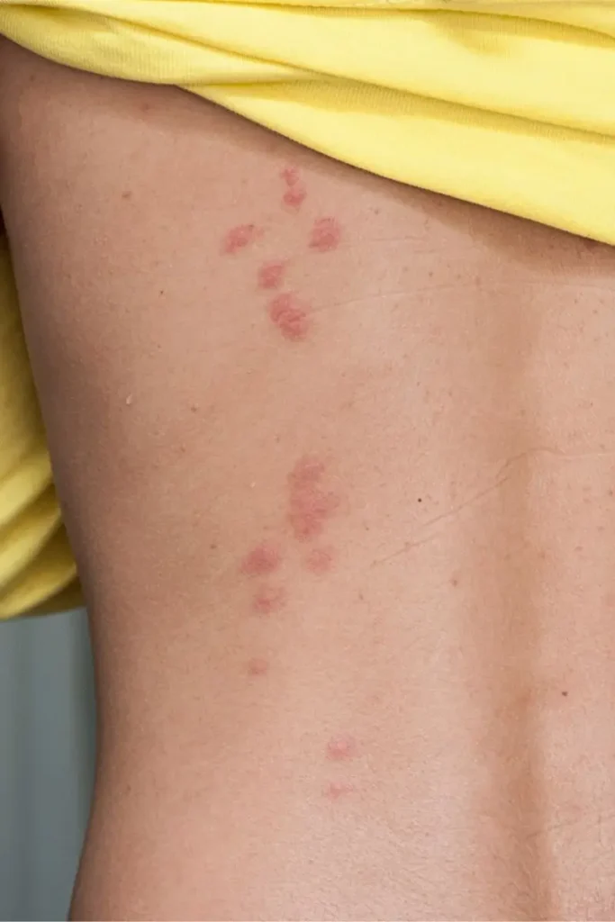 ugryzienia pluskwa.jpg